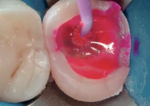 Peripheral Seal Concept For Deep Caries Removal End Points