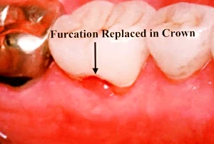 Perio-restorative treatment of complex cases by Daniel Melker