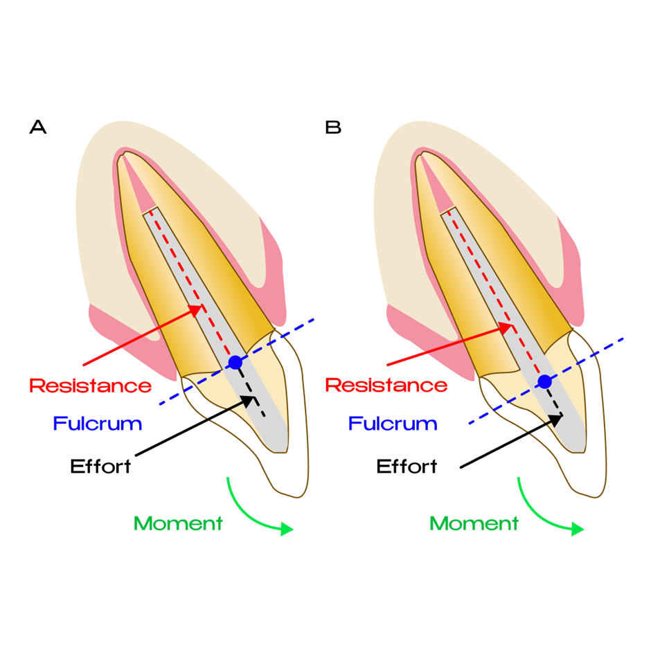 The Ferrule Effect In Restorative Dentistry Definition Guidelines