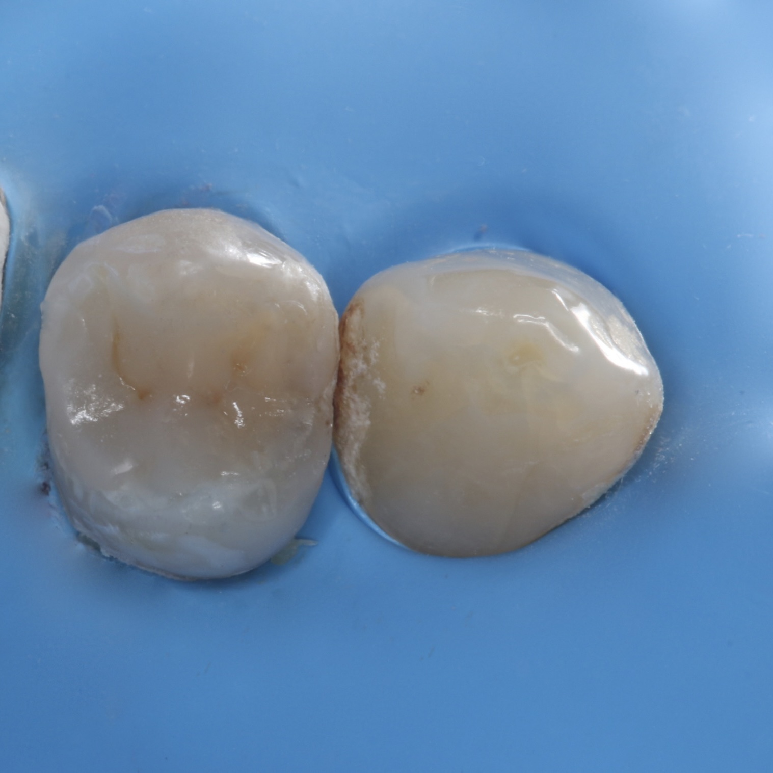 Glass ionomer cement, EQUIA, EverX, Endodontically treated