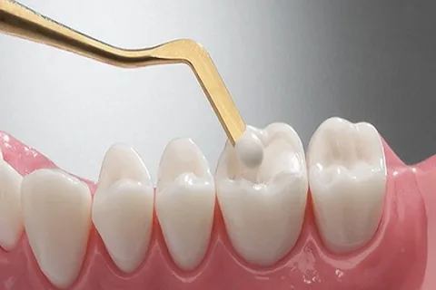 Restauraciones dentales