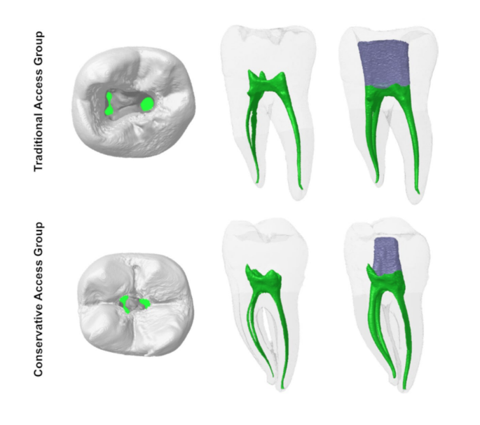 Impact Of Access Cavity Preparation On Dentine Thickness In Mandibular 
