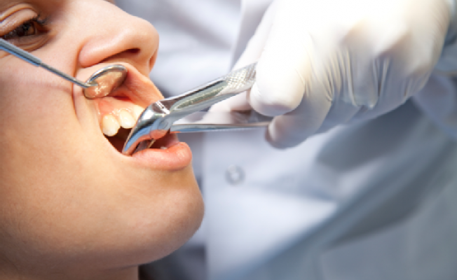 Estrazione denti del giudizio: fa male? Rischi e tecniche