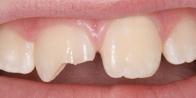 Травма зуба: что делать