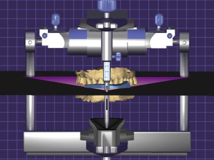 Maxilla Rotation Device Silicone Index Dental Workflow: Digital Maxilla Orientation