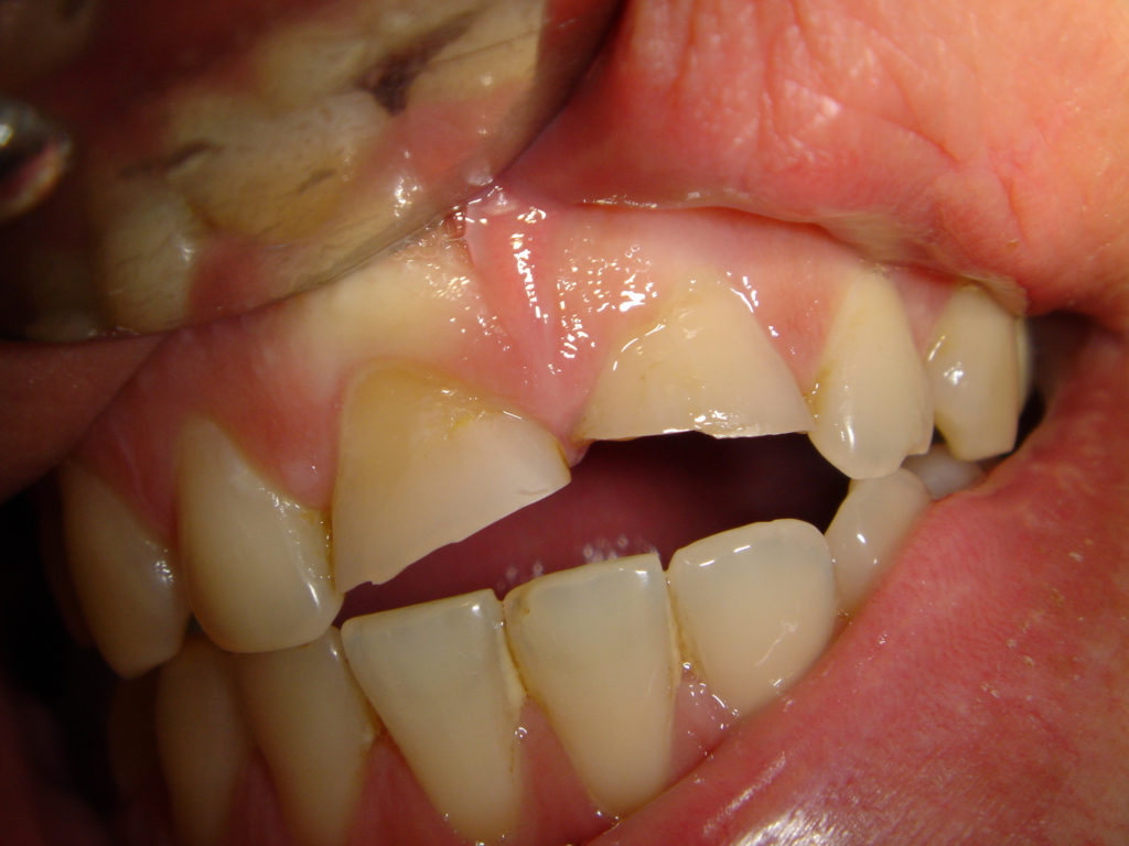 Реставрирование Зубов С Дефектами
