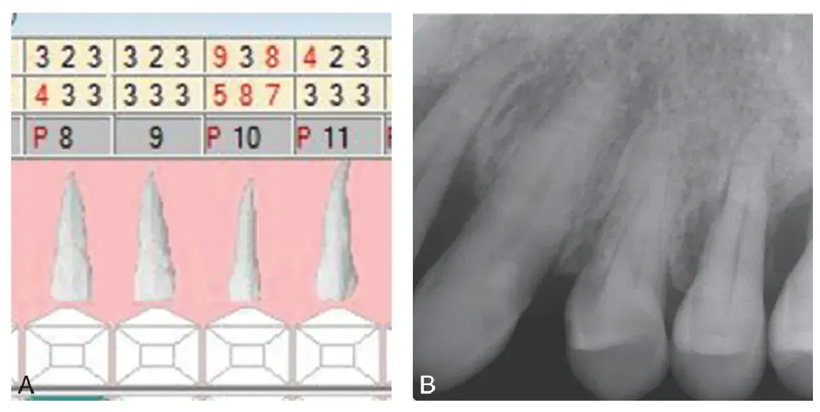 Site-specific nature of periodontal diseases