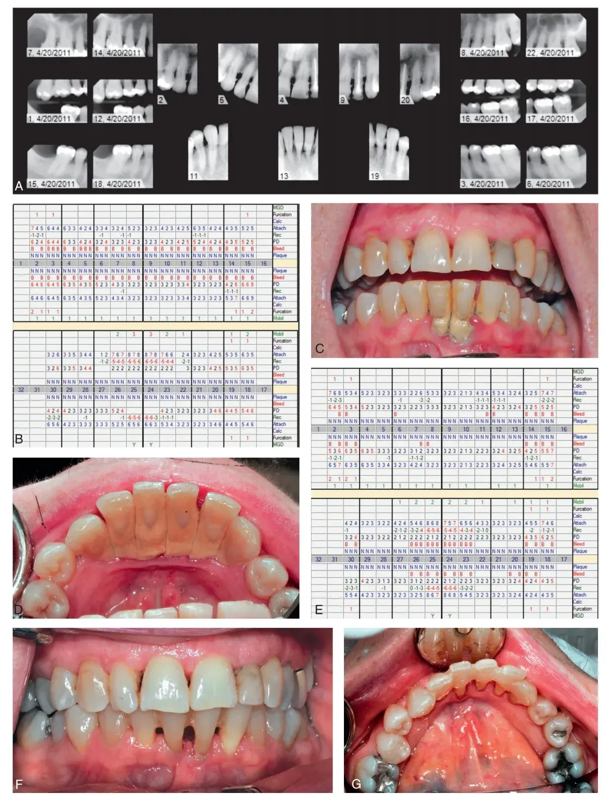Periodontal infection, shaping and root planning, gingival recession
