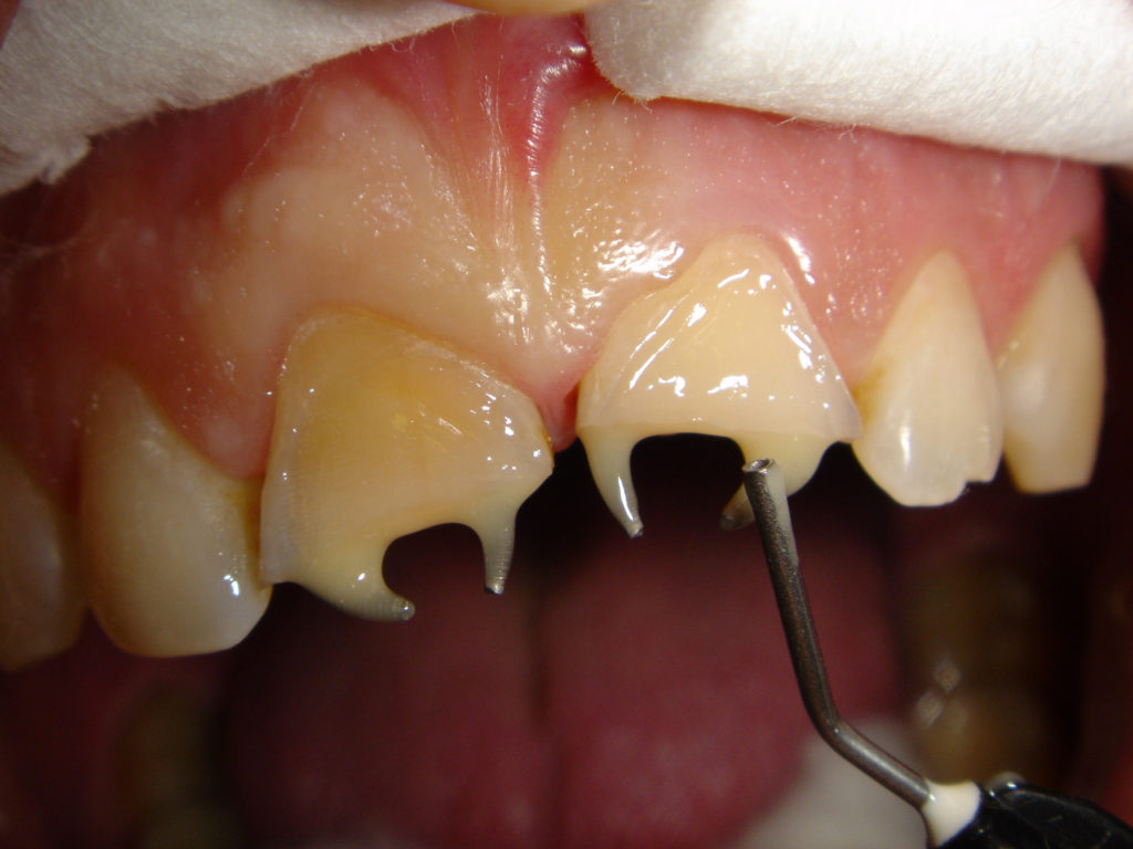 Реставрирование Зубов С Дефектами