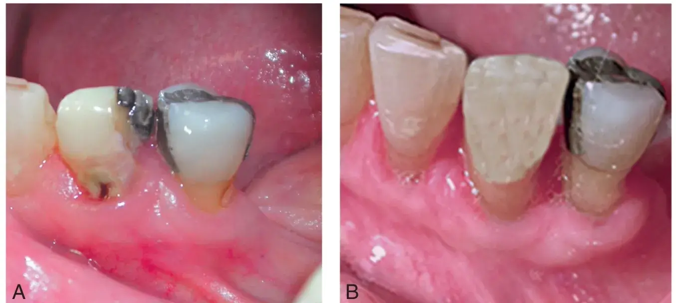 Caries, pulpitis, gingival healing after scaling and root planning