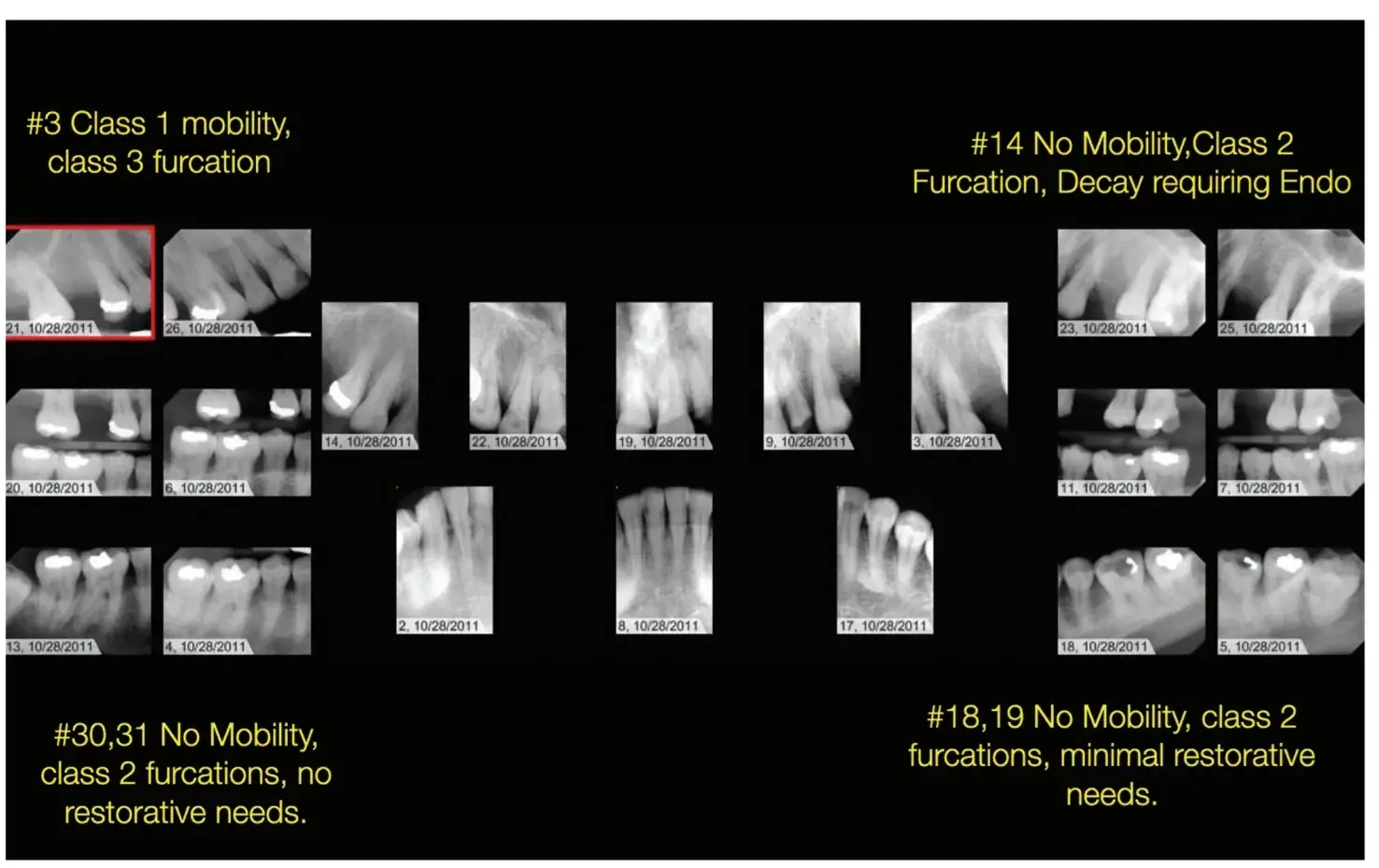X-ray, dental pictures, bone loss, furcation lesions