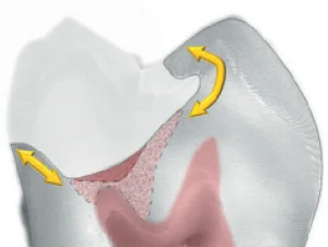 Caries removal end points