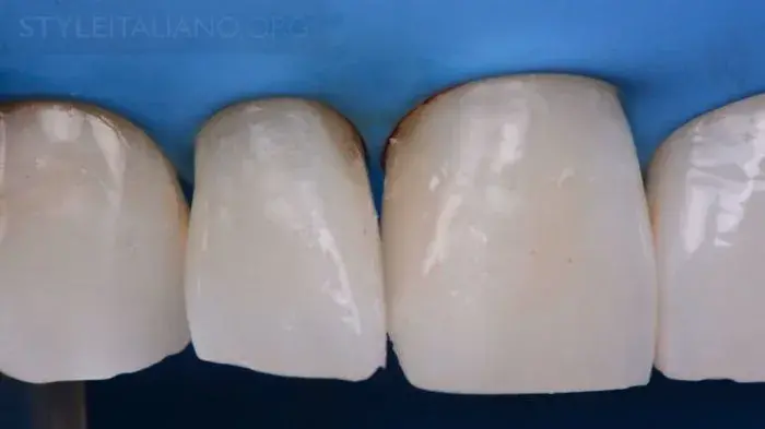 После удаления клинышка контакт проверяется при помощи зубной нити