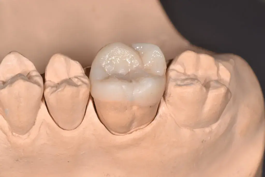 16 зуб в зубном ряду