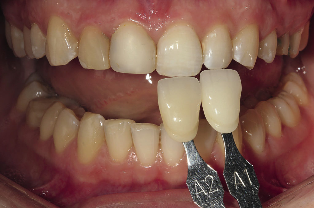 Рис. 10. Фотоснимок, демонстрирующий соответствие естественного цвета зуба cтандартным образцам шкалы Vita.