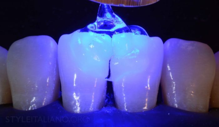 Реставрации Фронтальных Зубов