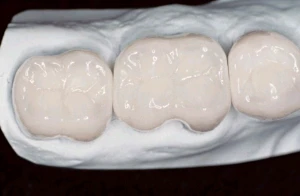 Restorations mimic shaped teeth