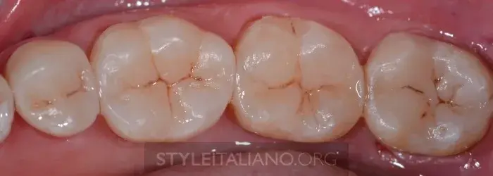 Окончательный вид восстановленных зубов после снятия коффердама