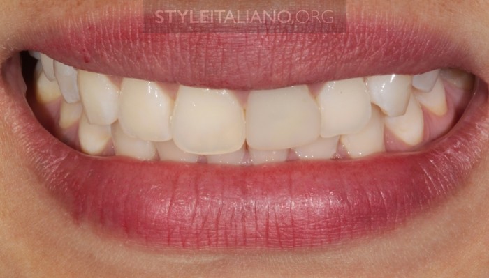 реставрация фронтальных зубов