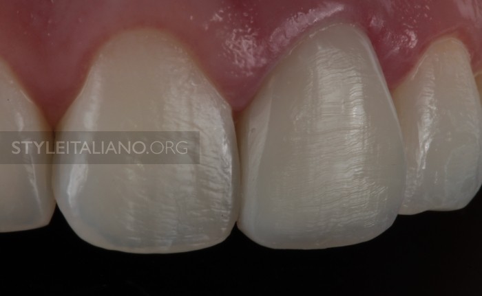 реставрация фронтальных зубов
