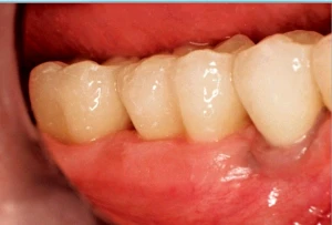 Restorations placed on mimic shaped teeth 