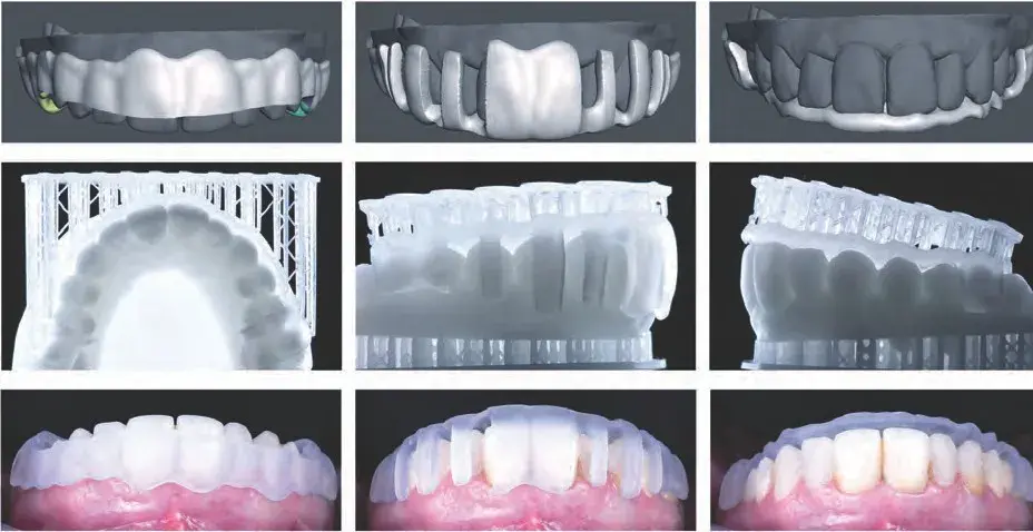 3D printed restoration guides