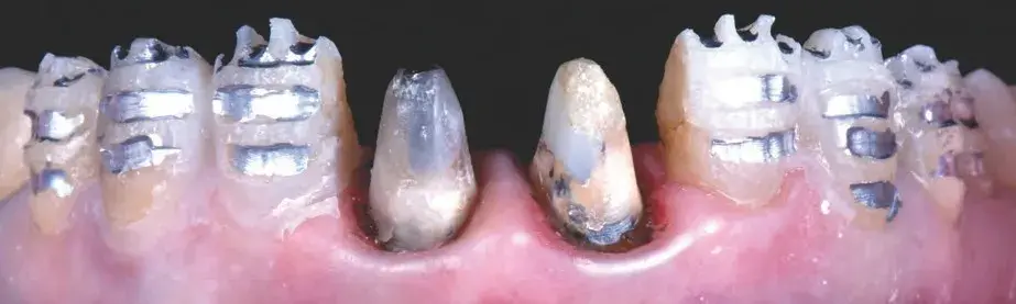 Guided tooth preparation