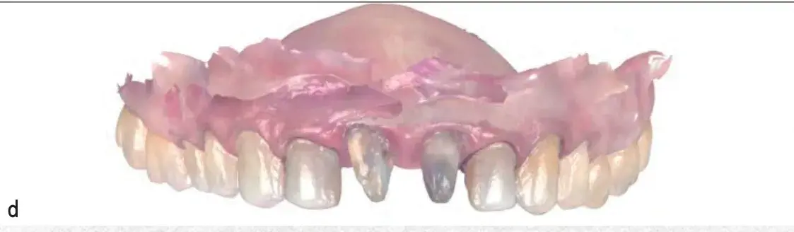 Intraoral scan of tooth preparation