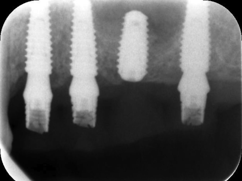 Рентген импланты