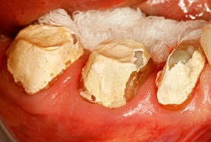 Minimal periodontal issues