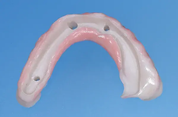Циркониевая часть после нанесения слоя керамики со щечной стороны для имитации цвета зубов и розового оттенка десны