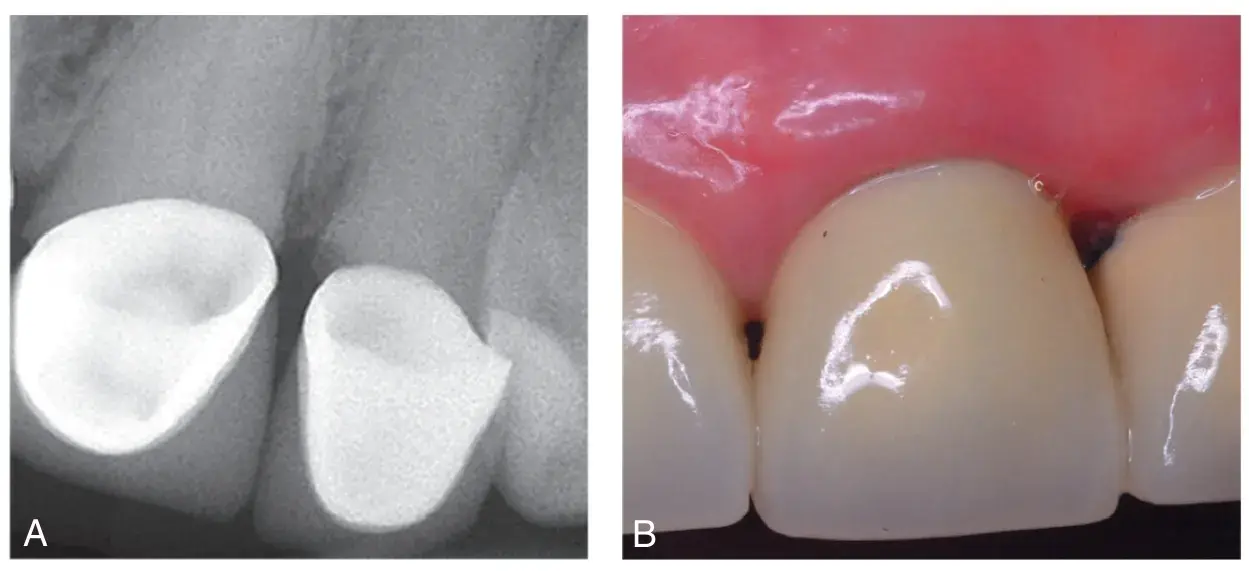 Inflammation with bone loss and destruction of interdental papilla