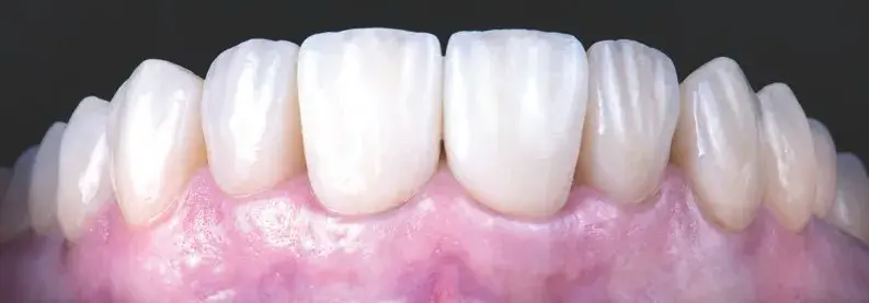 Indirect tooth restorations