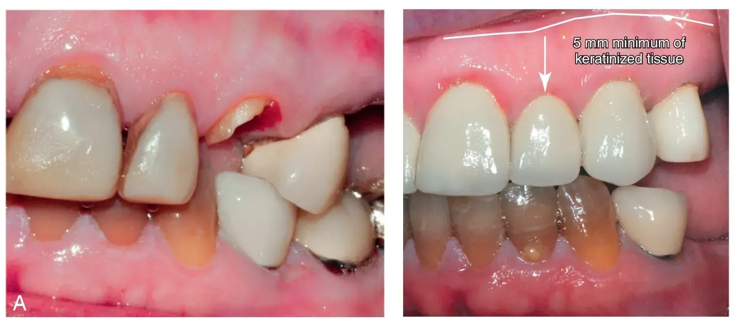 Discoloration, incisor extraction, perio-restorative treatment