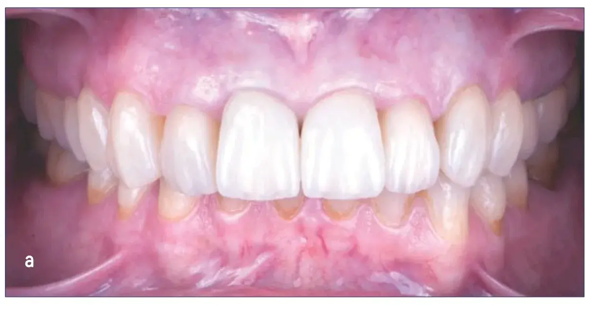 Indirect tooth restorations