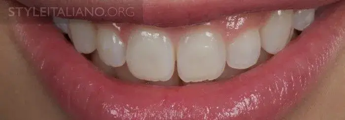 Микроабразию и/или отбеливание проводят после завершения минерализации зуба