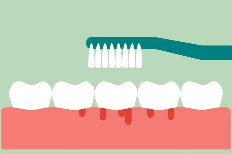Неправильные движения при чистке зубов, неаккуратное очищение межзубных промежутков