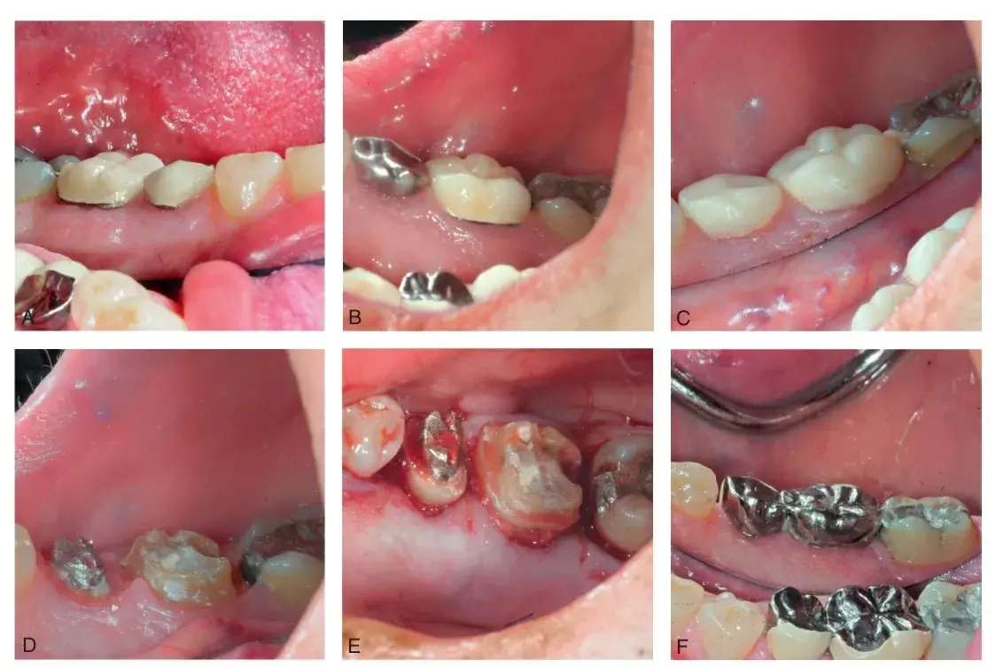 Surgical crown lengthening and prosthetic rehabilitation