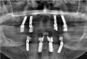 Radiography after implant placement