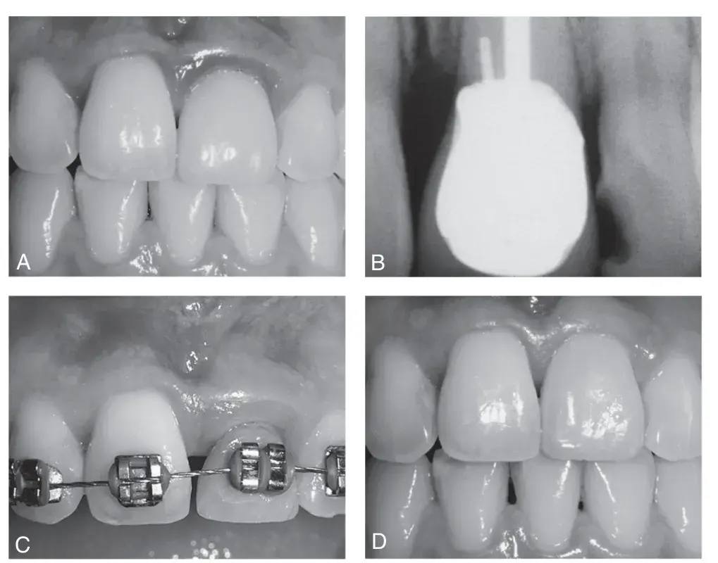 Orthodontic correction of biologic width