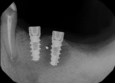 All about peri-implantitis