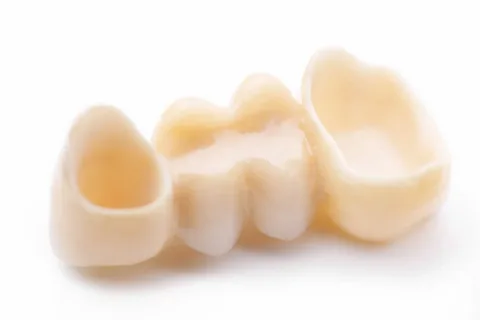 Провизорные протезы в стоматологии