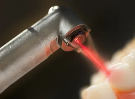 Noções básicas de preparação a laser