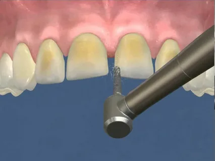 Обзор методов препарирования зубов
