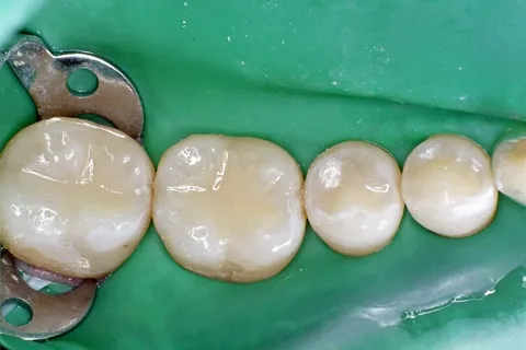 Modeling of composite restorations of posterior teeth