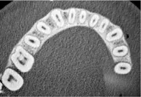 Поперечное сечение каналов зубов
