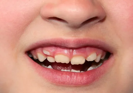 Аномалии развития отдельных зубов