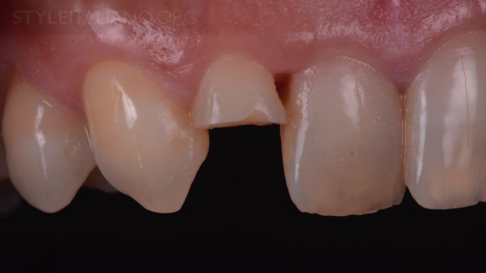 фрагмент зуба