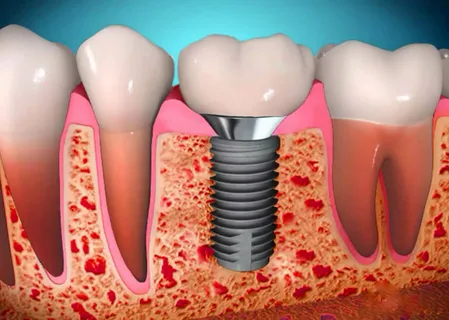 Morphological basis of dental implantation