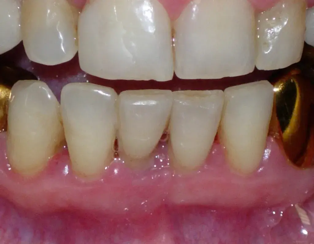 Клиника зуб 4.1 подлежит удалению